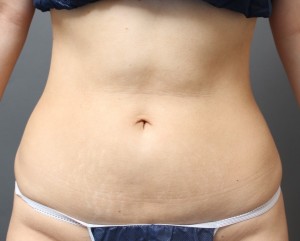 腹部から腰の脂肪吸引