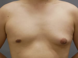 女性化乳房 乳腺切除
