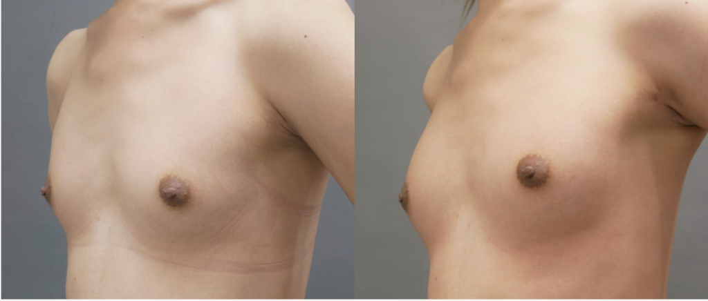 男性の豊胸手術（術後１ヶ月との比較）