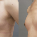 男性の豊胸手術（術後１ヶ月との比較）